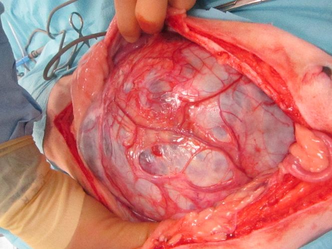 The appearance of the splenic mass at surgery